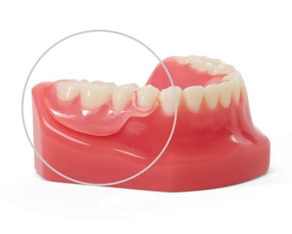 Partial Denture