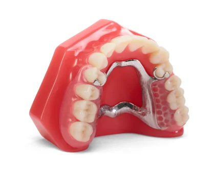 Partial Denture